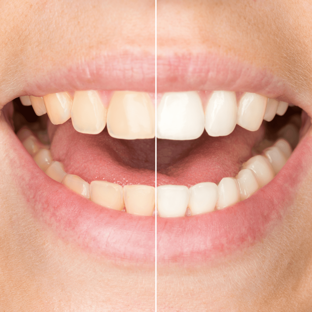 Transformación Dental en ODONTOVIDA Cali - Comparación de sonrisas antes y después de un tratamiento