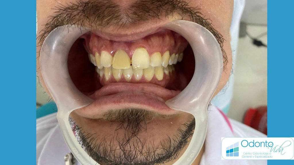 Resultado del tratamiento de urgencia dental en ODONTOVIDA Cali - Clínica Odontológica en Cali, Colombia